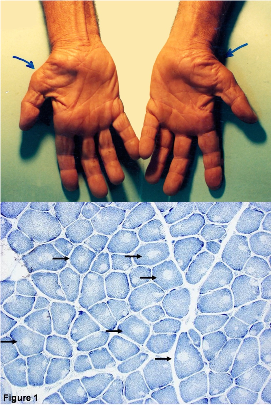 Clinical presentation of hand muscle wasting and corresponding nerve biopsy cross-section