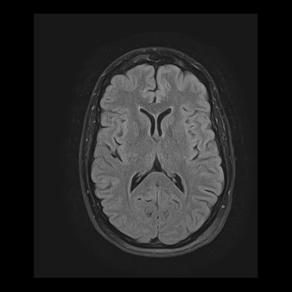 Axial MRI brain scan